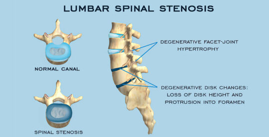 Lumbar Spinal Stenosis - TriMed Spine & Joint