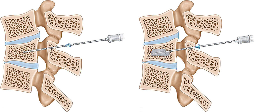 Vertebral Augmentation - Trimed Spine & Joint