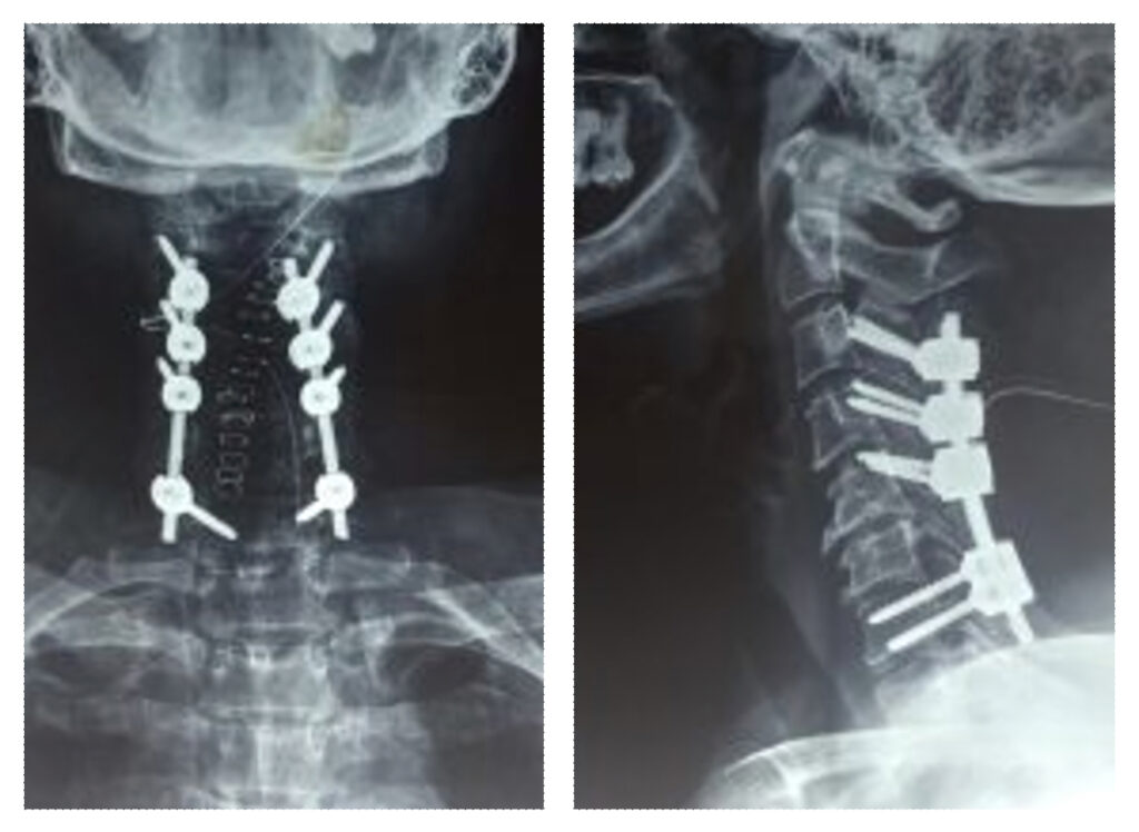 Cervical Laminectomy | TriMed Spine & Joint