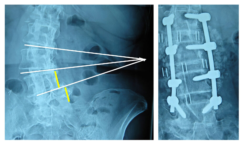 Minimally Invasive Xlif Trimed Spine And Joint