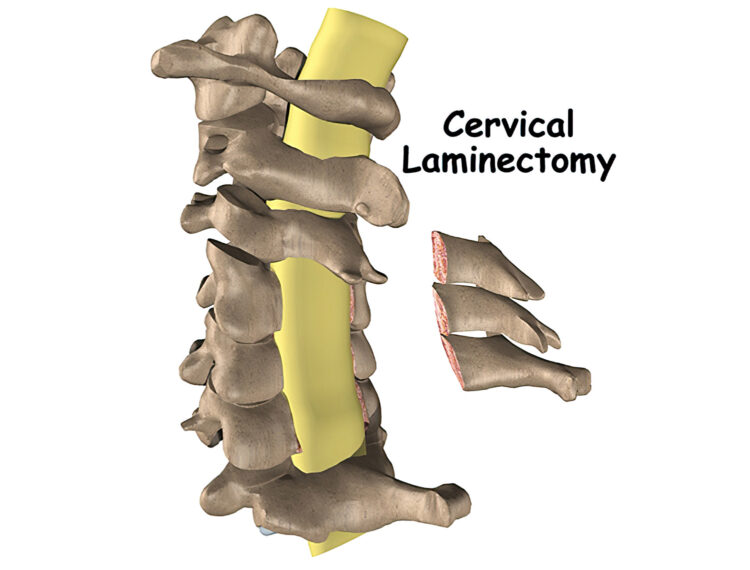 Cervical Laminectomy | TriMed Spine & Joint