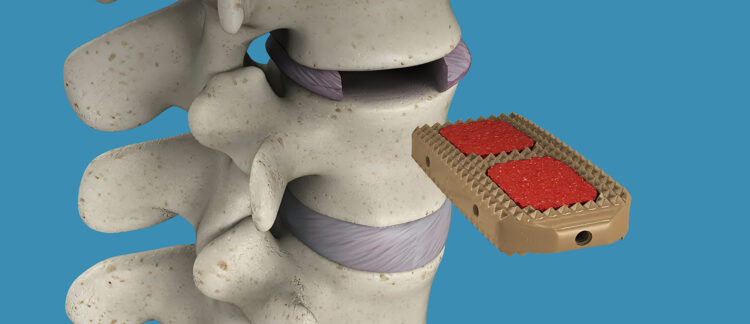 Minimally Invasive XLIF | TriMed Spine & Joint