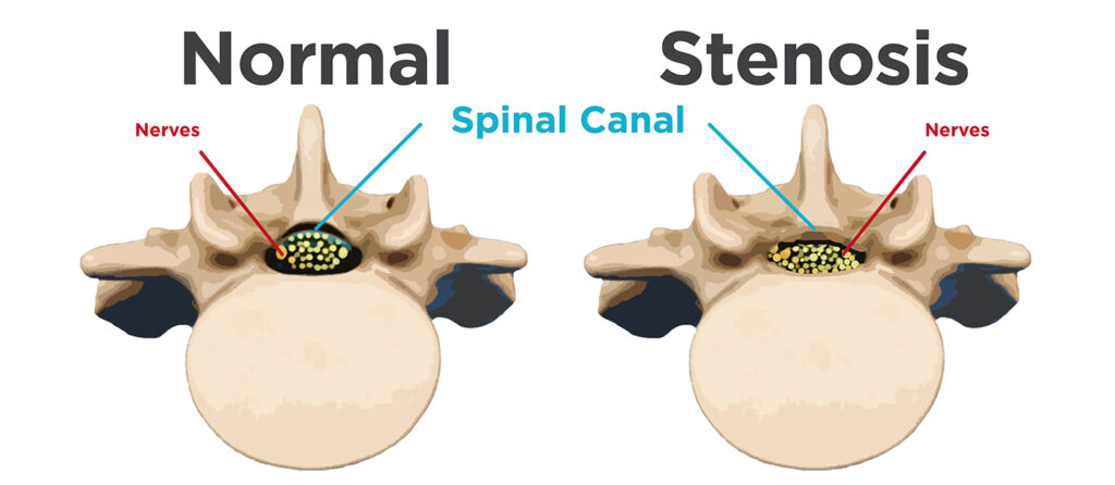 Lumbar Spinal Stenosis - TriMed Spine & Joint