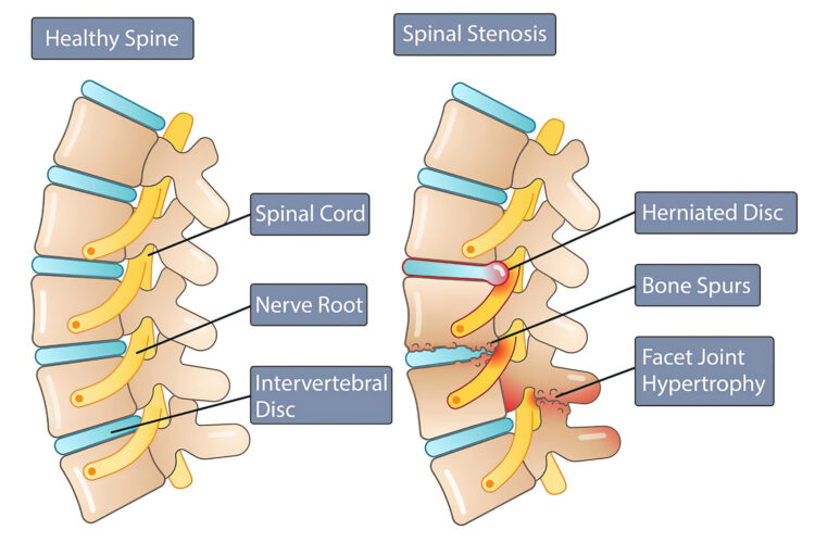 Cervical Stenosis | TriMed Spine & Joint