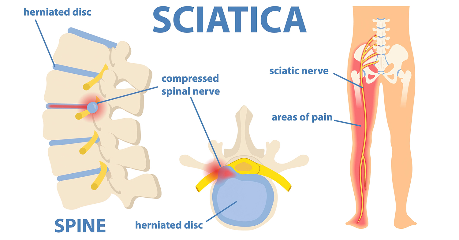170920183_l-scaled-gigapixel-low_res-scale-6_00x Sciatica diagram showing a herniated disc compressing the sciatic nerve and the areas of leg pain it causes