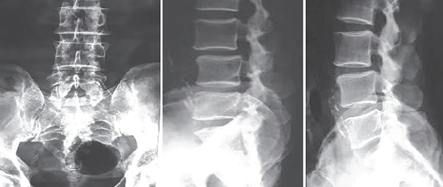 Spondylolisthesis | TriMed Spine & Joint