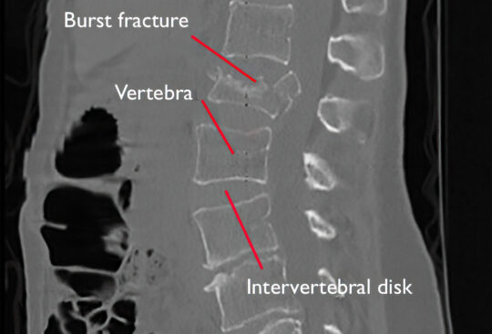 Back Fracture | TriMed Spine & Joint