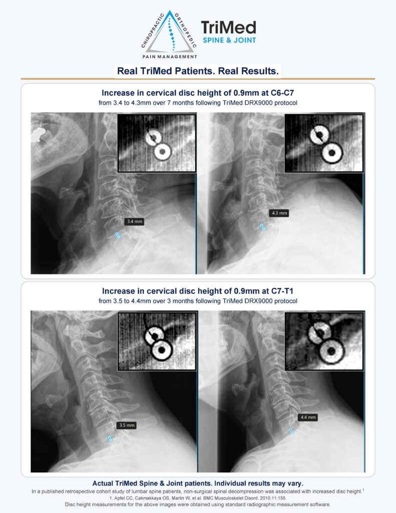 Before and after x-ray images showing increased cervical disc height at C6-C7 and C7-T1 in two TriMed Spine & Joint patients following DRX9000 spinal decompression therapy