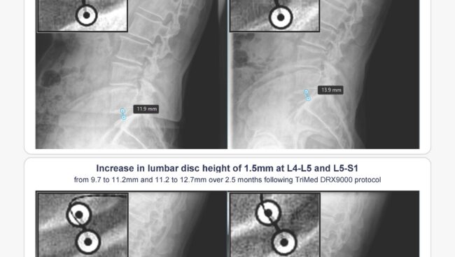 Before and after lumbar spine x-rays showing increased disc height at L4-L5 and L5-S1 following DRX9000 spinal decompression therapy