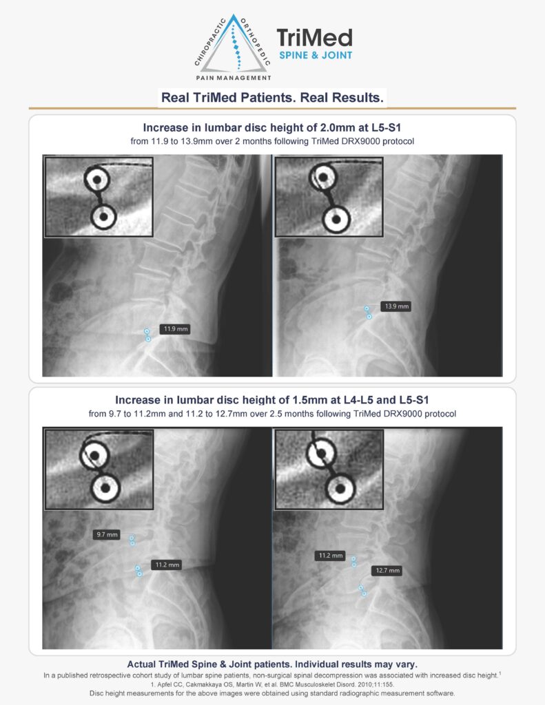 Before and after x-ray images showing increased lumbar disc height at L5-S1 and L4-L5 in two TriMed Spine & Joint patients following DRX9000 spinal decompression therapy