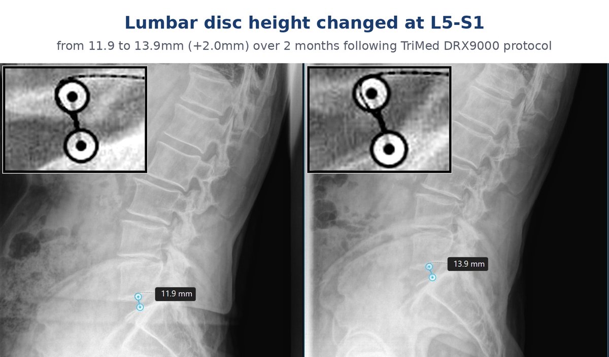 Before and after lumbar X-ray showing a 2.0 mm disc height change at L5-S1, from 11.9 mm to 13.9 mm, following DRX9000 spinal decompression at TriMed Spine & Joint in Boca Raton