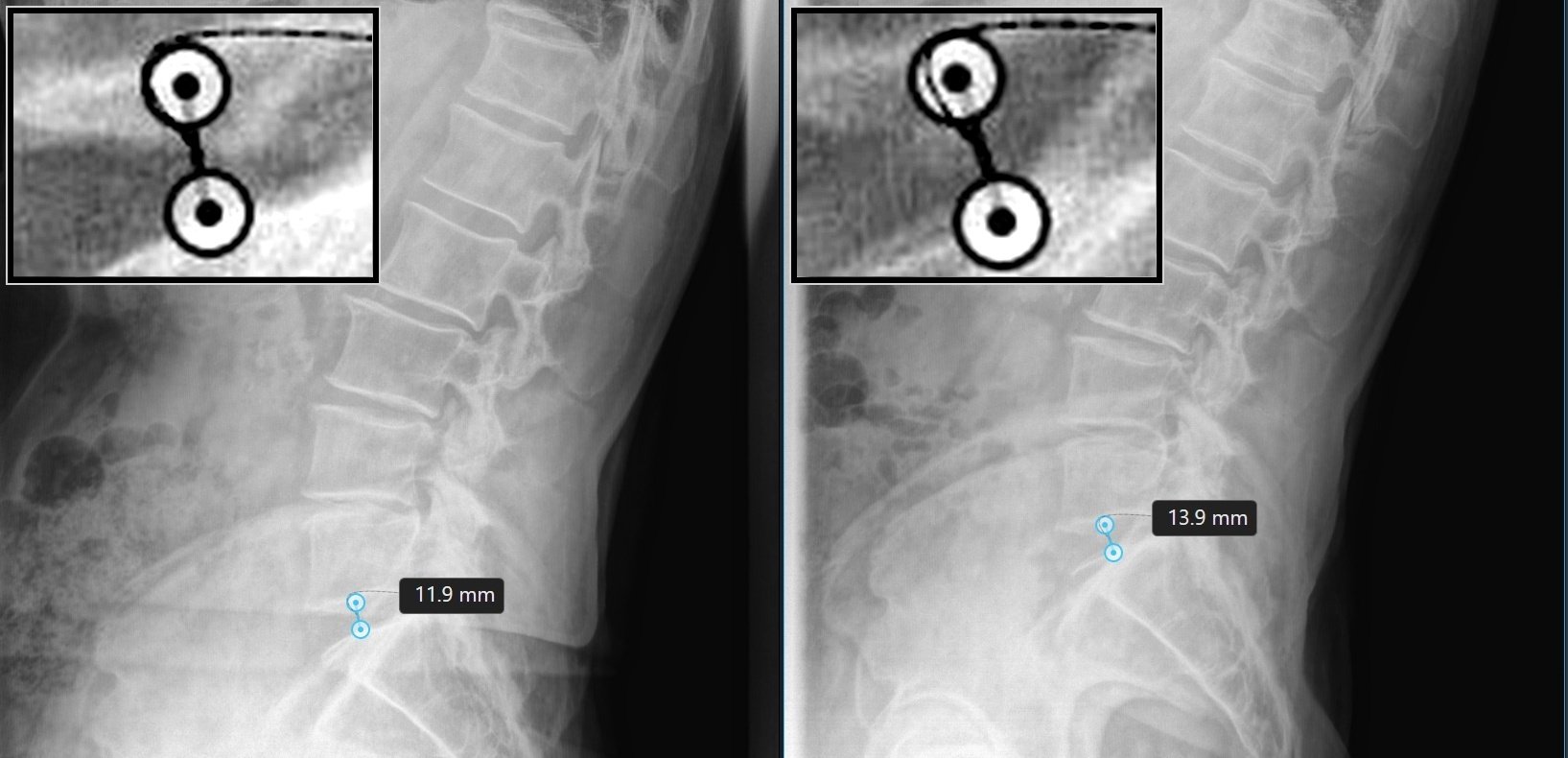 Before and after lateral lumbar X-ray films showing disc height change at L5-S1 following DRX9000 spinal decompression at TriMed Spine & Joint