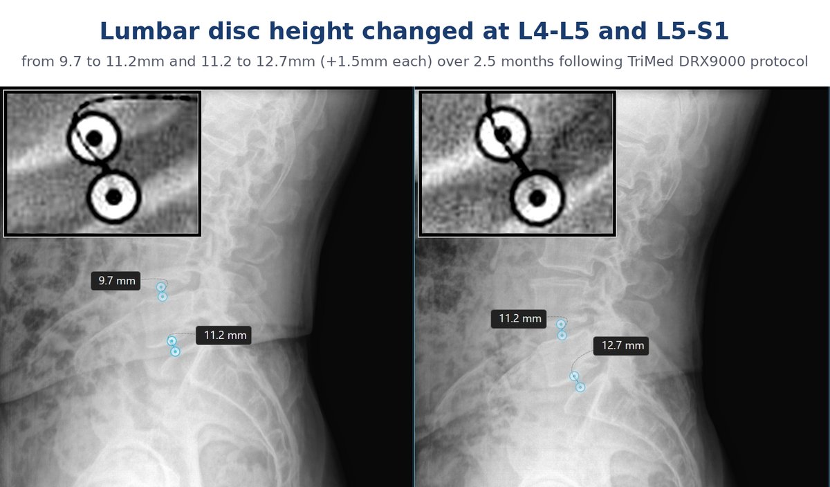 Before and after lumbar X-ray showing a 1.5 mm disc height change at L4-L5 and L5-S1, from 9.7 mm to 11.2 mm and from 11.2 mm to 12.7 mm, following DRX9000 spinal decompression at TriMed Spine & Joint in Boca Raton
