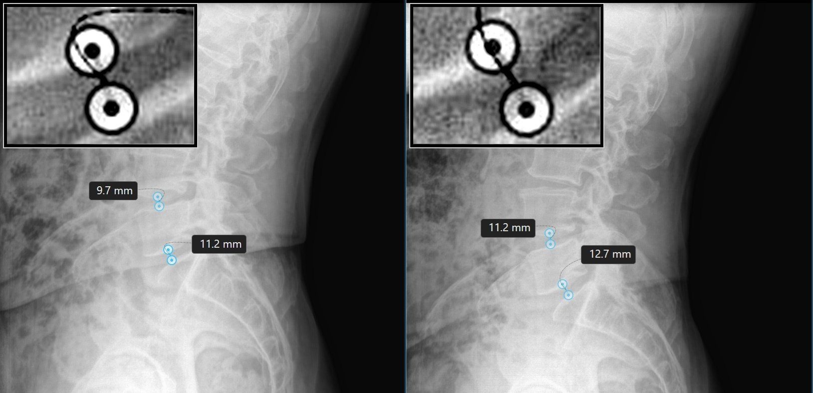 Before and after lateral lumbar X-ray films showing disc height changes at L4-L5 and L5-S1 following DRX9000 spinal decompression at TriMed Spine & Joint