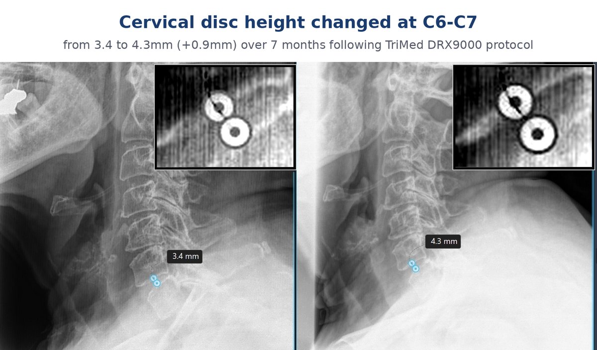 Before and after cervical X-ray showing a 0.9 mm disc height change at C6-C7, from 3.4 mm to 4.3 mm, following DRX9000 spinal decompression at TriMed Spine & Joint in Boca Raton