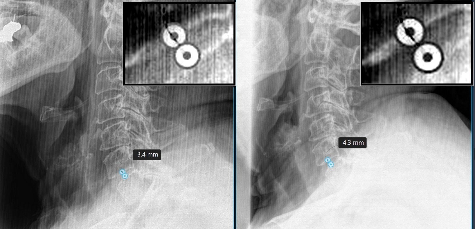 Before and after lateral cervical X-ray films showing disc height change at C6-C7 following DRX9000 spinal decompression at TriMed Spine & Joint