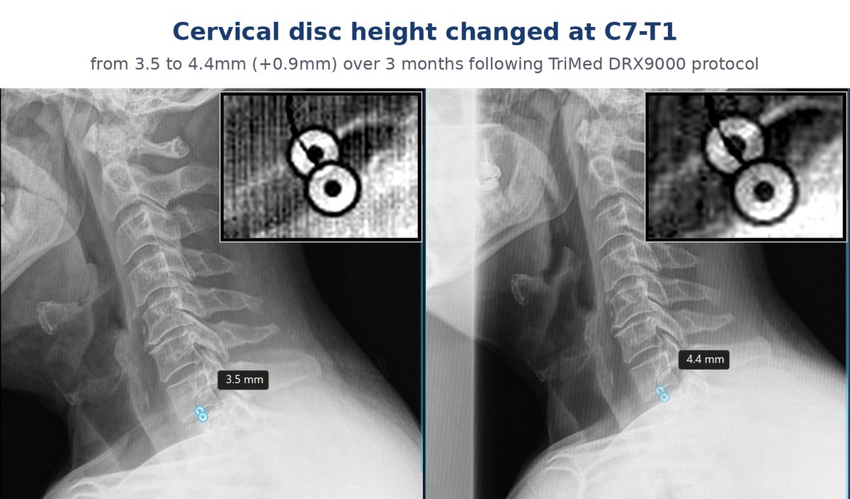 Before and after cervical X-ray showing a 0.9 mm disc height change at C7-T1, from 3.5 mm to 4.4 mm, following DRX9000 spinal decompression at TriMed Spine & Joint in Boca Raton