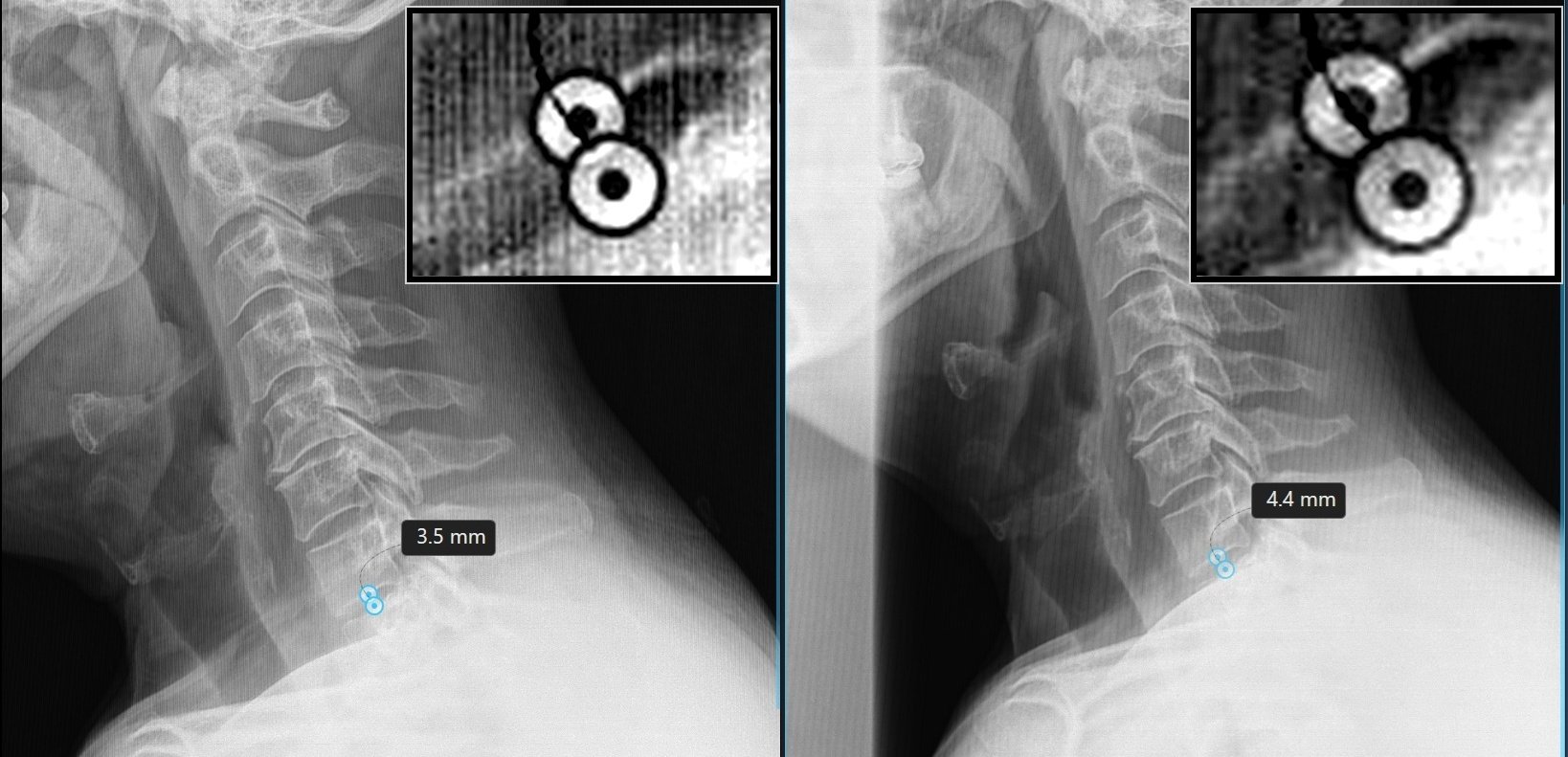 Before and after lateral cervical X-ray films showing disc height change at C7-T1 following DRX9000 spinal decompression at TriMed Spine & Joint