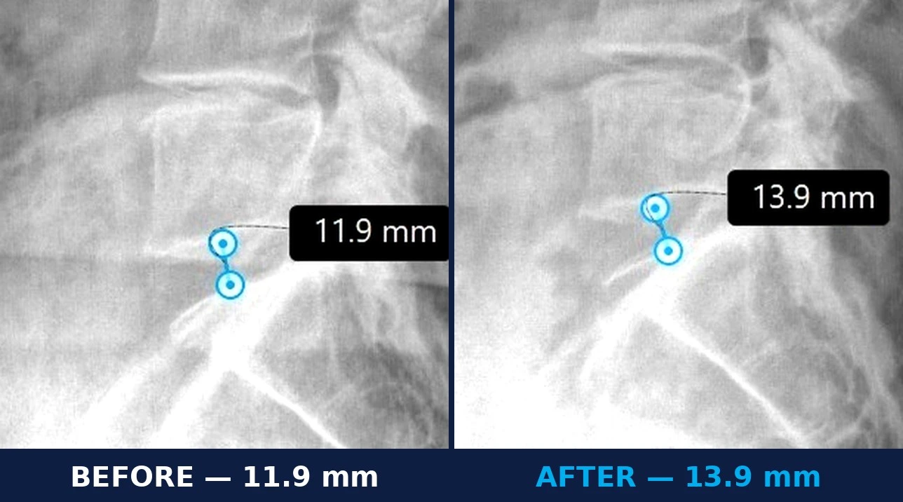 Lumbar disc height before and after DRX9000 at L5-S1 Close-up before and after lateral X-ray comparison showing L5-S1 disc height increasing from 11.9 mm to 13.9 mm after the TriMed DRX9000 protocol